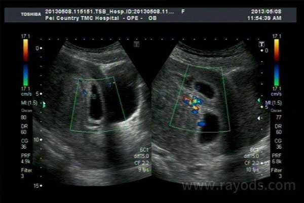 淮安助孕生殖医院代孕产子,「试管放2个胚胎成功高吗」如何知道自己宫腔粘连